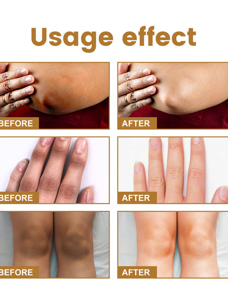 Jaysuing Knuckle Acanthosis Melanin Whitening Serum For Hand And Joint Skin